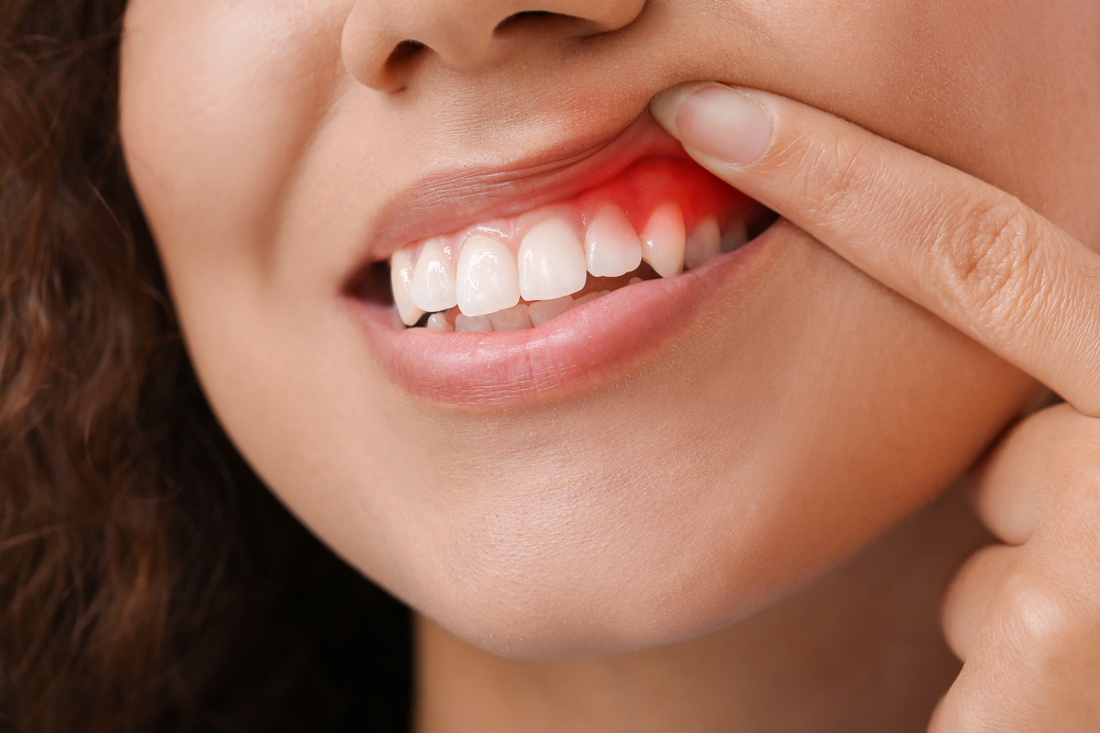 Periodontal disease